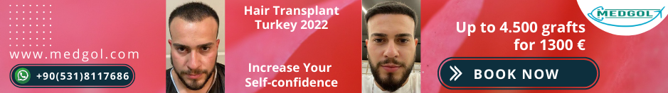 Hair Transplant in Turkey Prices & packages