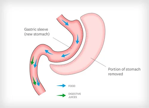 The Process of Gastric Sleeve Surgery in Antalya