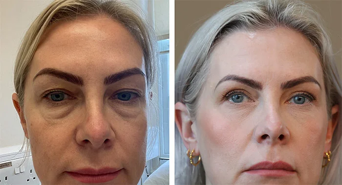 Before and Aftercare Tips for Blepharoplasty