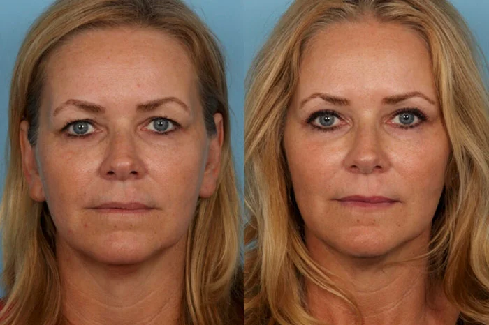 Patients Who Have Undergone Blepharoplasty in Antalya