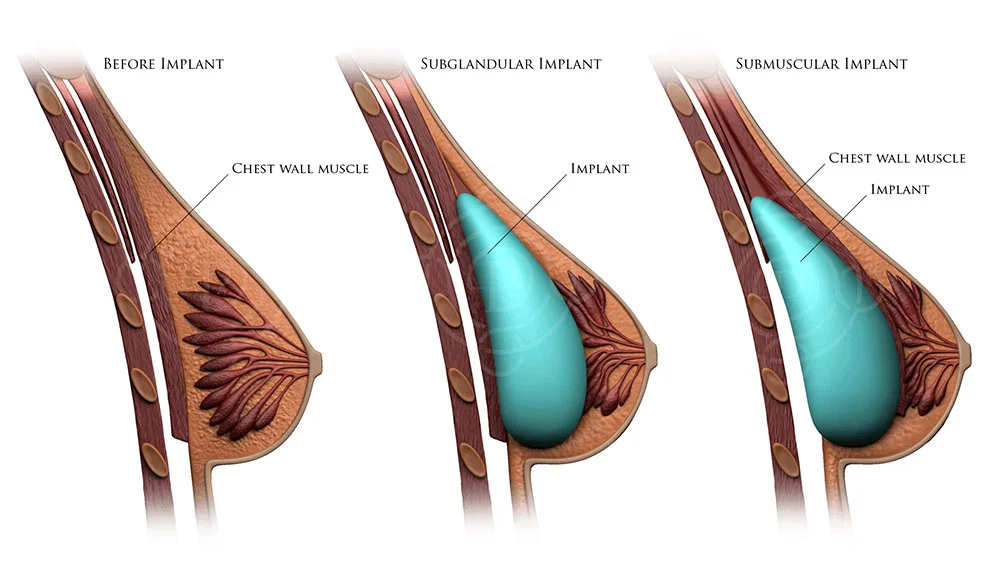 Breast Augmentation Procedure