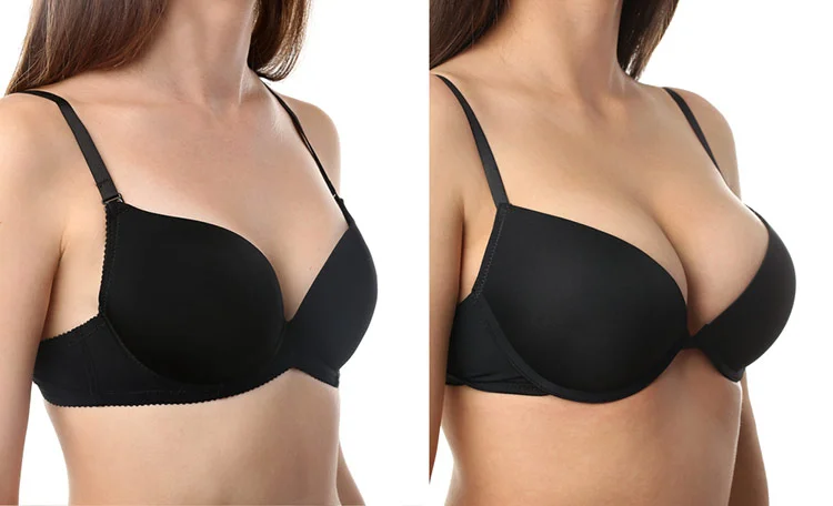 Breast Augmentation in Antalya