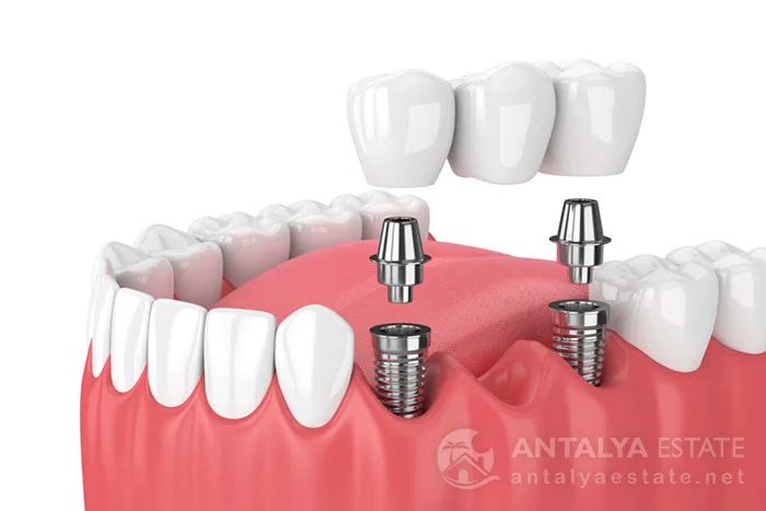 Dental Implants in Antalya