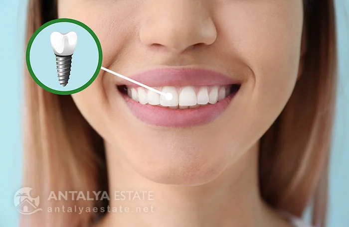 Dental Implants in Antalya