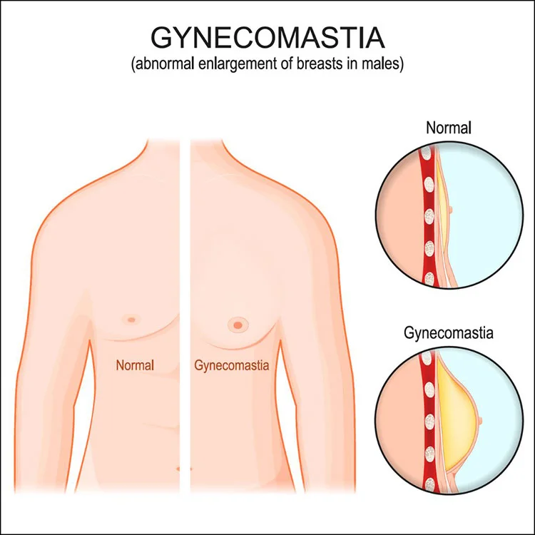 Gynecomastia Surgery in Antalya