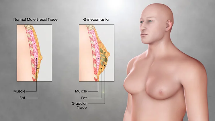 The psychological impact of gynecomastia