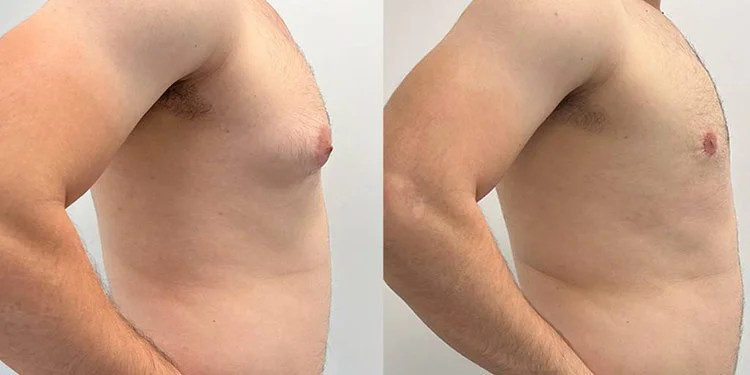 The gynecomastia surgery procedure in Antalya