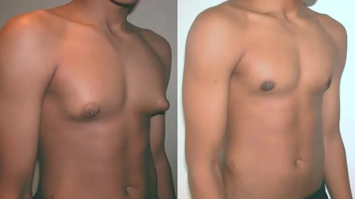 Preparing for gynecomastia surgery