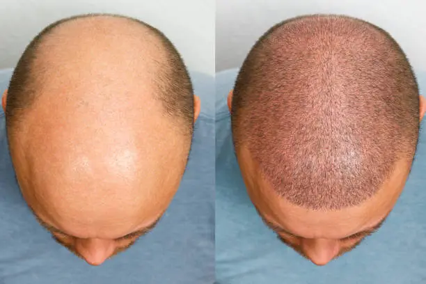 hair transplant in Antalya