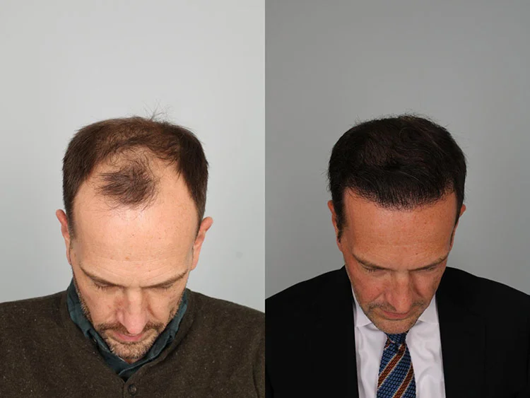 Preparing for a hair transplant in Antalya