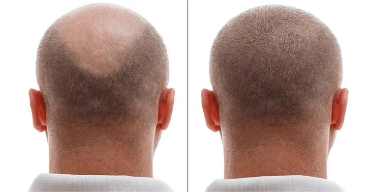 hair transplant in Antalya