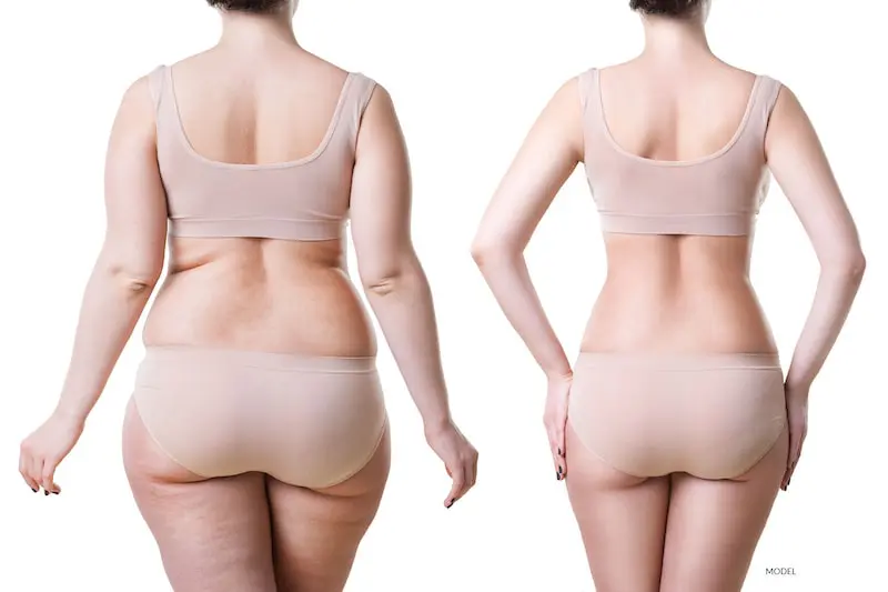 Liposuction in Antalya