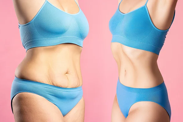 Liposuction in Antalya